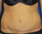 Abdominoplasty