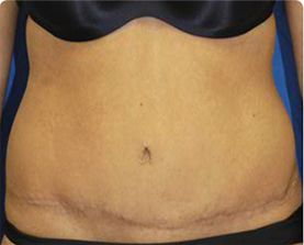 Abdominoplasty