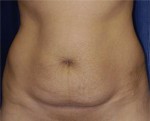 Abdominoplasty