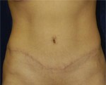 Abdominoplasty