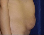 Abdominoplasty