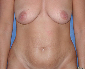 Abdominoplasty