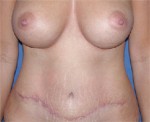 Abdominoplasty