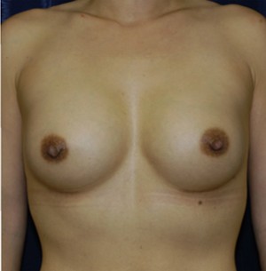 Breast Augmentation