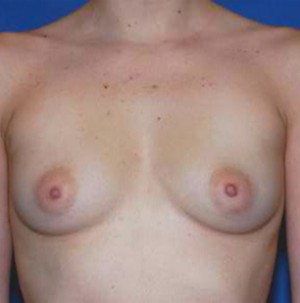 Breast Augmentation