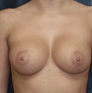 Breast Augmentation