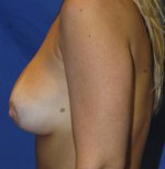 Breast Augmentation with Lift