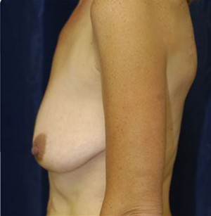 Breast Augmentation with Lift