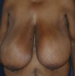 Breast Reduction