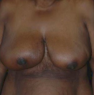 Breast Reduction