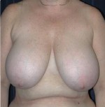 Breast Reduction