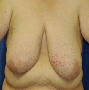 Breast Reduction