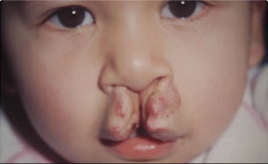 Cleft Palate / Cleft Lip