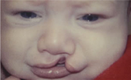 Cleft Palate / Cleft Lip