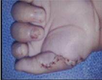 Congenital Deformities Case 3280 After Photo Congenital Deformities