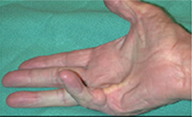 Dupuytren's Contracture