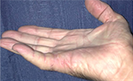 Dupuytren's Contracture