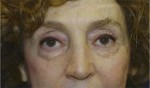 Eyelid (Blepharoplasty)