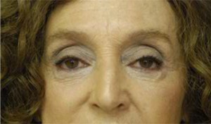 Eyelid (Blepharoplasty)