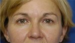 Eyelid (Blepharoplasty)