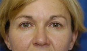 Eyelid (Blepharoplasty)