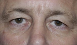 Eyelid (Blepharoplasty)