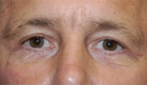 Eyelid (Blepharoplasty)