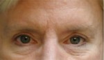 Eyelid (Blepharoplasty)