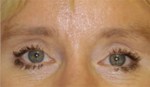 Eyelid (Blepharoplasty)