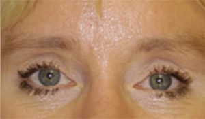 Eyelid (Blepharoplasty)