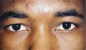 Eyelid (Blepharoplasty)