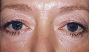 Eyelid (Blepharoplasty) Case 3010 Before Photo Eyelid (Blepharoplasty)