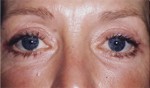 Eyelid (Blepharoplasty)