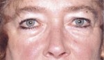 Eyelid (Blepharoplasty)