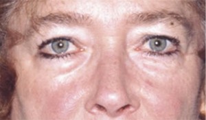 Eyelid (Blepharoplasty) Case 3014 Before Photo Eyelid (Blepharoplasty)