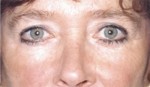 Eyelid (Blepharoplasty)