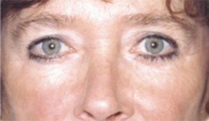Eyelid (Blepharoplasty) Case 3014 After Photo Eyelid (Blepharoplasty)