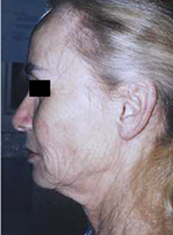 Facelift Case 3070 Before Photo Facelift