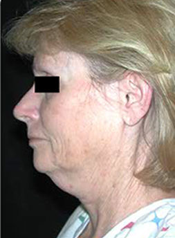 Facelift Case 3076 Before Photo Facelift
