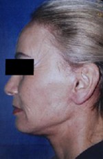 Natural Neck Lift