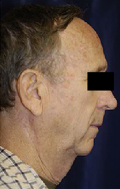 Natural Neck Lift Case 3034 Before Photo Natural Neck Lift