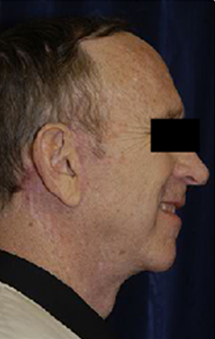 Natural Neck Lift Case 3034 After Photo Natural Neck Lift