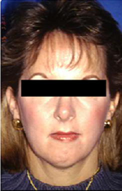 Natural Neck Lift Case 3042 Before Photo Natural Neck Lift