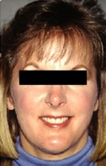 Natural Neck Lift