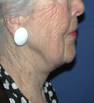 Natural Neck Lift