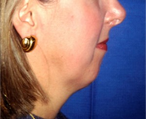 Natural Neck Lift Case 3042 Before Photo Natural Neck Lift