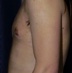 Gynecomastia