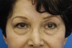 Eyelid (Blepharoplasty)