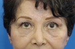 Eyelid (Blepharoplasty)