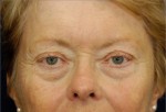 Eyelid (Blepharoplasty)